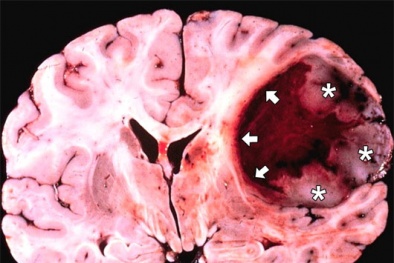 Hai loại protein gây ung thư não